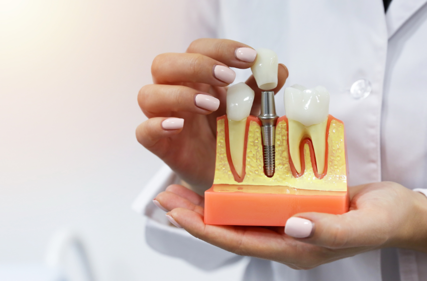  Kiek laiko tarnaus dantų implantai?  Atsako odontologė