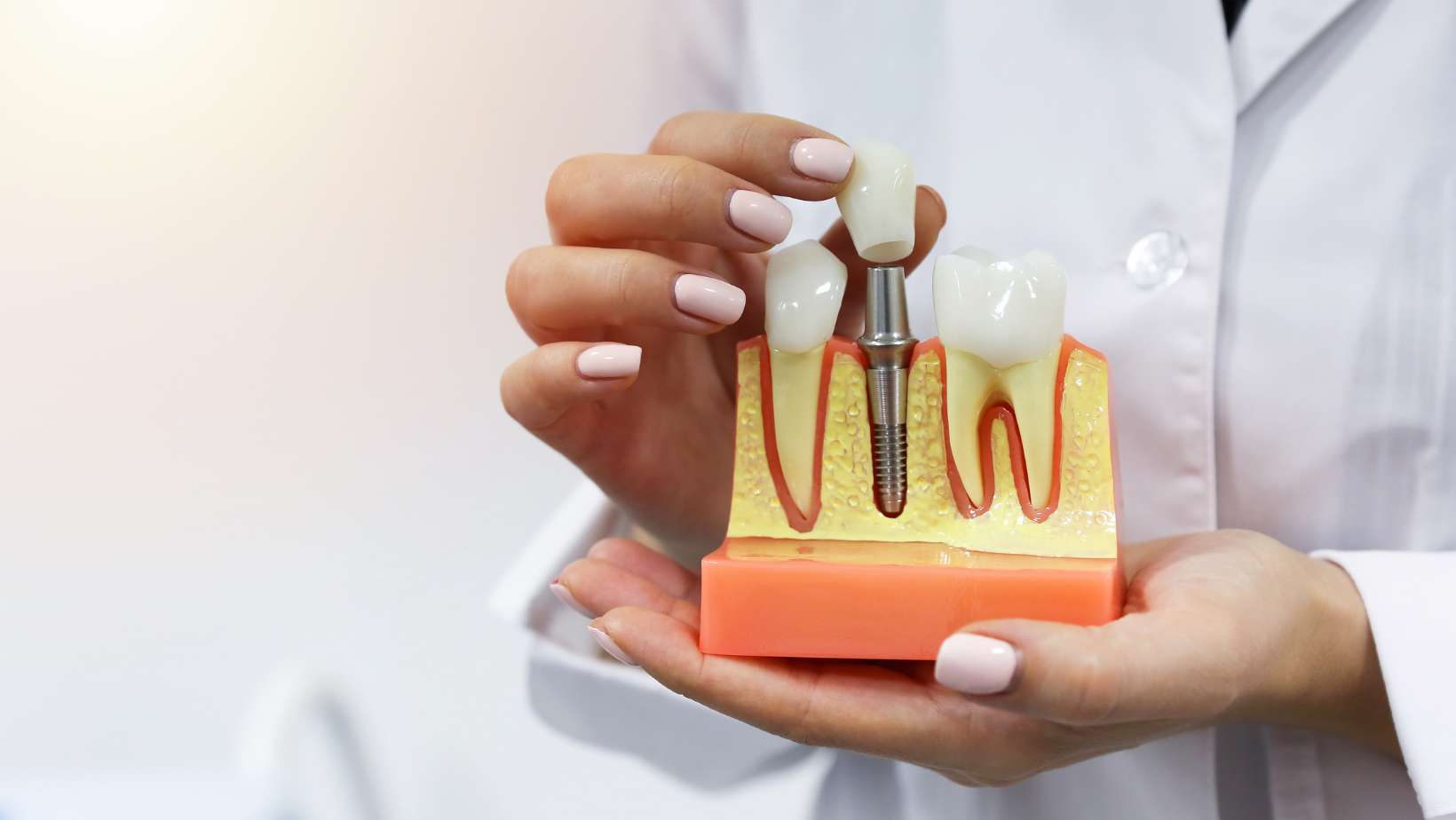 How lengthy will dental implants final?  The dentist solutions